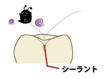 シーラントで歯の溝を埋めた状態（乳歯の断面図）