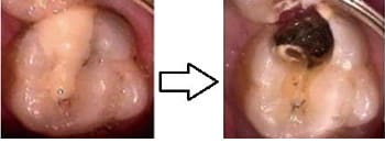 第2次虫歯になる前と後