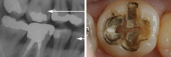 銀歯の詰め物の下にある二次虫歯の様子